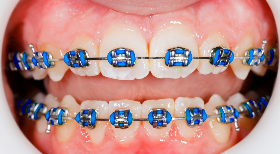 Ortodonzia - Dentalworld clinica dentale ed odontoiatrica